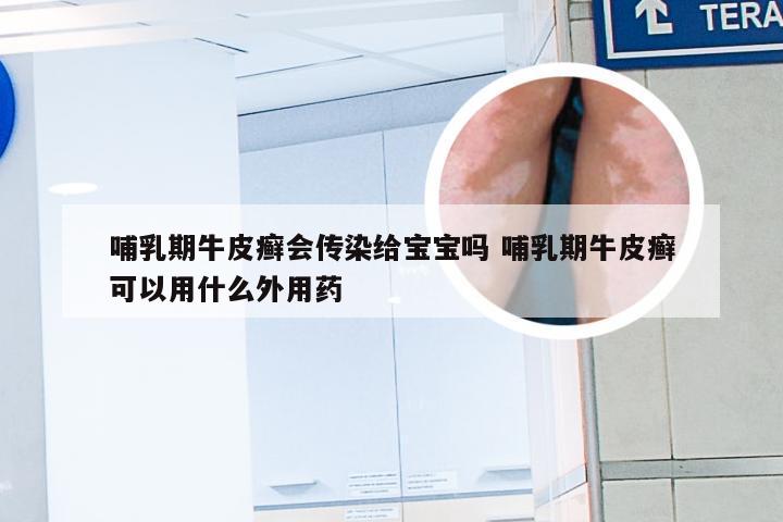 哺乳期牛皮癣会传染给宝宝吗 哺乳期牛皮癣可以用什么外用药