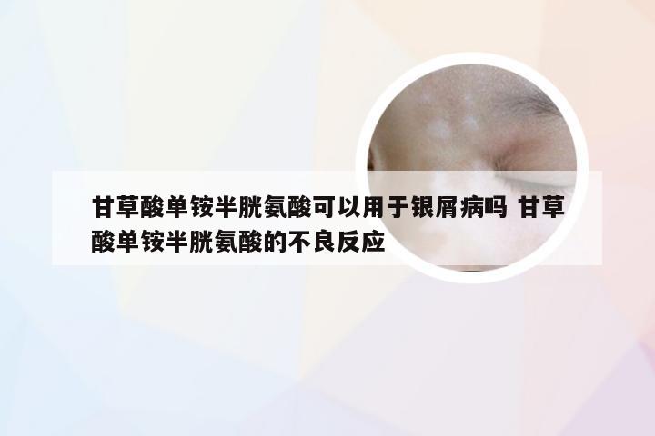甘草酸单铵半胱氨酸可以用于银屑病吗 甘草酸单铵半胱氨酸的不良反应
