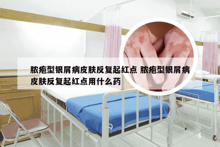 脓疱型银屑病皮肤反复起红点 脓疱型银屑病皮肤反复起红点用什么药