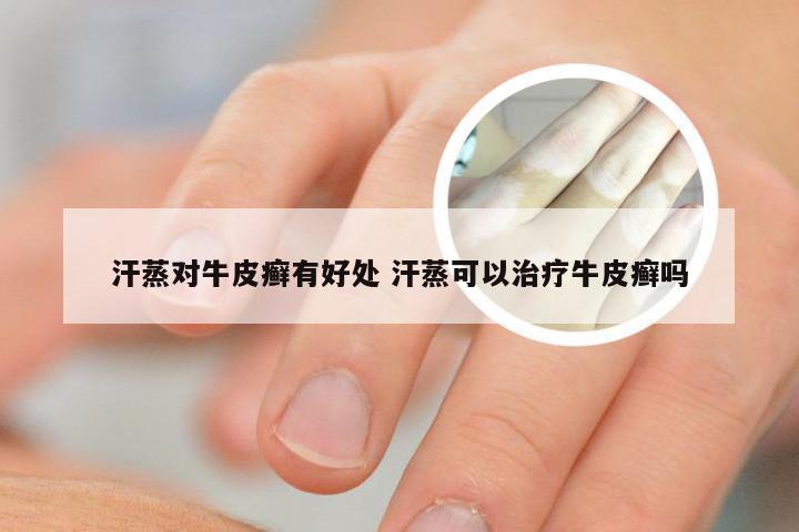 汗蒸对牛皮癣有好处 汗蒸可以治疗牛皮癣吗