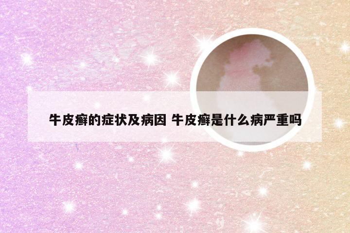 牛皮癣的症状及病因 牛皮癣是什么病严重吗