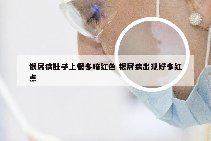 银屑病肚子上很多暗红色 银屑病出现好多红点