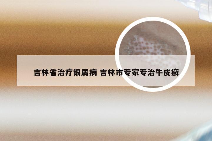 吉林省治疗银屑病 吉林市专家专治牛皮癣