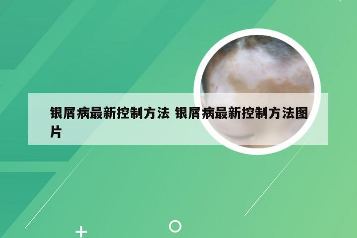 银屑病最新控制方法 银屑病最新控制方法图片