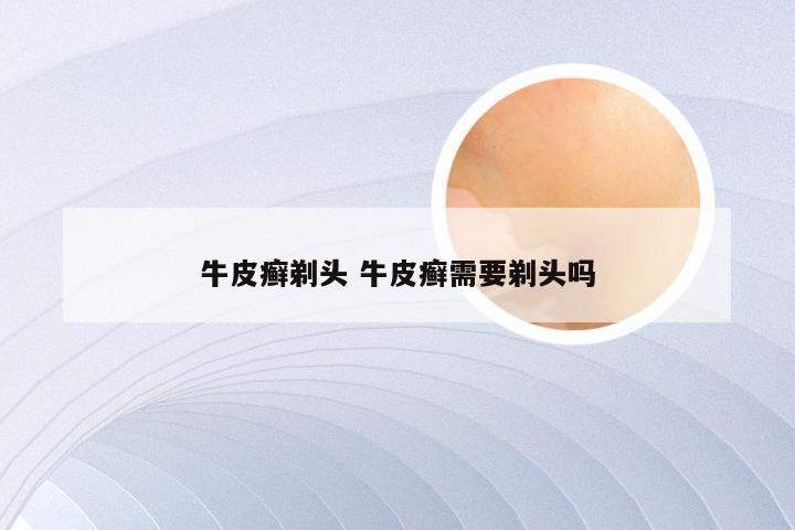 牛皮癣剃头 牛皮癣需要剃头吗
