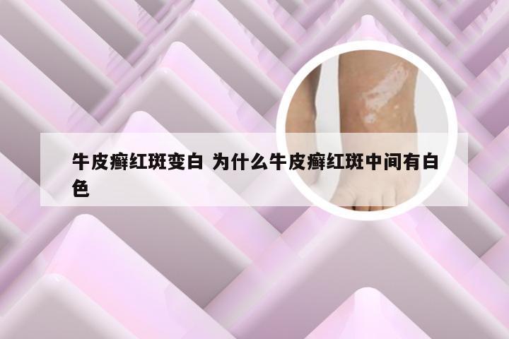 牛皮癣红斑变白 为什么牛皮癣红斑中间有白色