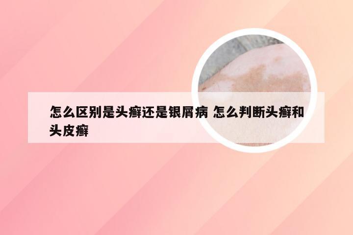 怎么区别是头癣还是银屑病 怎么判断头癣和头皮癣