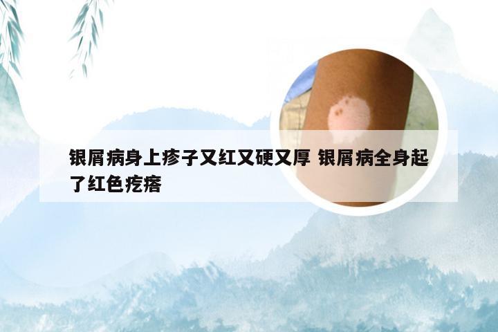 银屑病身上疹子又红又硬又厚 银屑病全身起了红色疙瘩