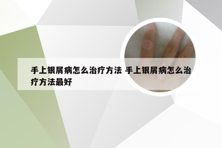 手上银屑病怎么治疗方法 手上银屑病怎么治疗方法最好