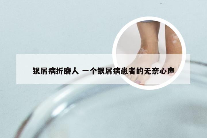 银屑病折磨人 一个银屑病患者的无奈心声