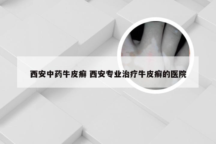 西安中药牛皮癣 西安专业治疗牛皮癣的医院