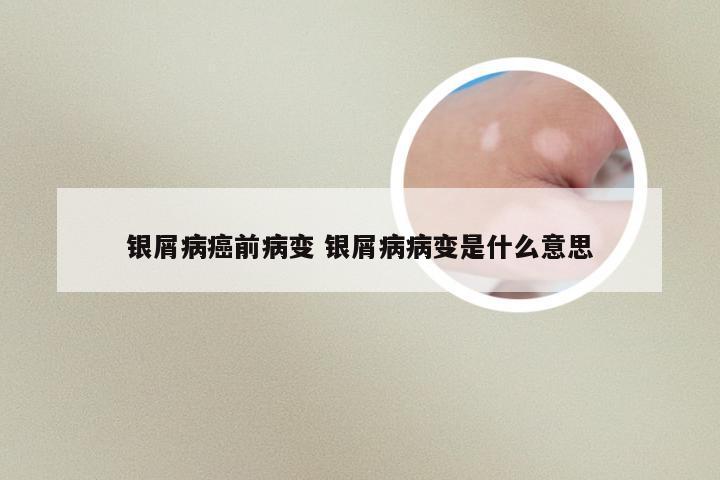 银屑病癌前病变 银屑病病变是什么意思