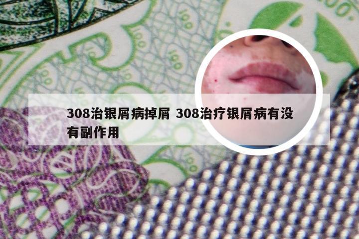 308治银屑病掉屑 308治疗银屑病有没有副作用