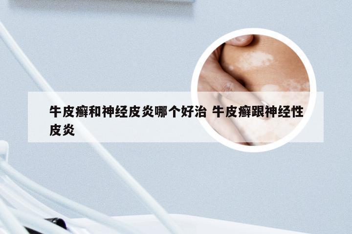 牛皮癣和神经皮炎哪个好治 牛皮癣跟神经性皮炎
