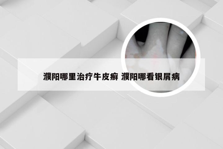 濮阳哪里治疗牛皮癣 濮阳哪看银屑病