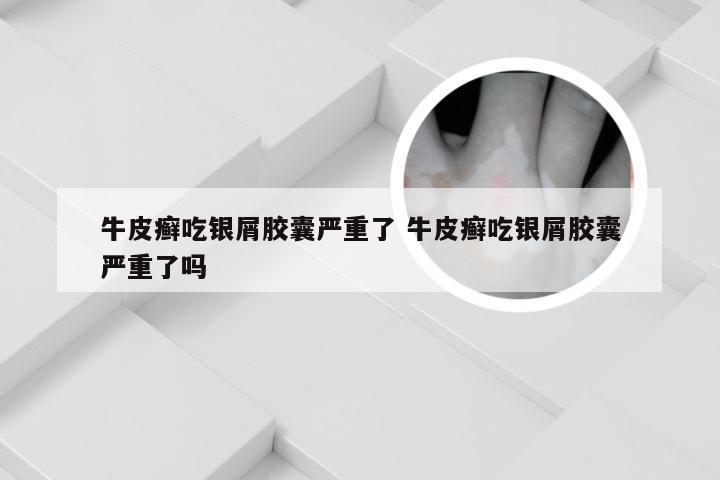牛皮癣吃银屑胶囊严重了 牛皮癣吃银屑胶囊严重了吗