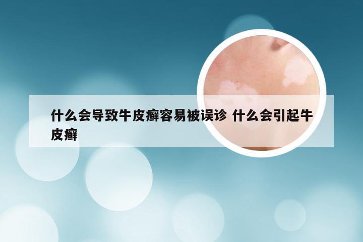 什么会导致牛皮癣容易被误诊 什么会引起牛皮癣