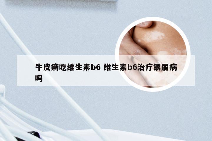 牛皮癣吃维生素b6 维生素b6治疗银屑病吗