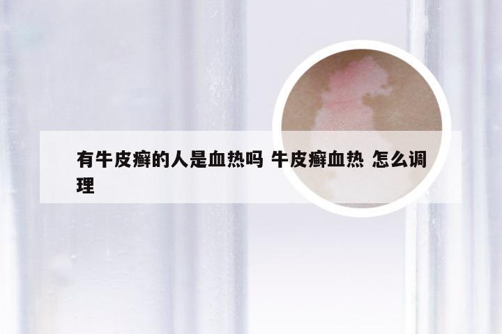 有牛皮癣的人是血热吗 牛皮癣血热 怎么调理