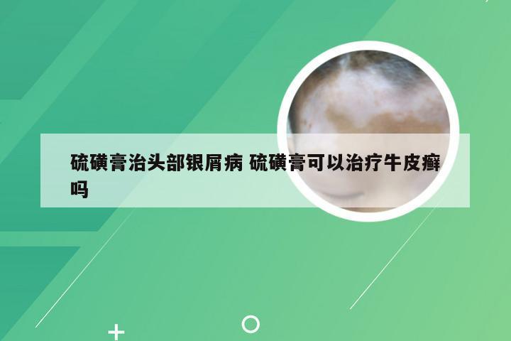 硫磺膏治头部银屑病 硫磺膏可以治疗牛皮癣吗