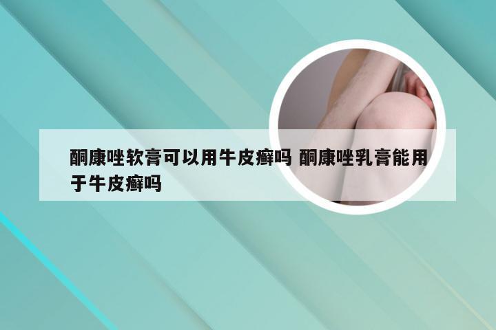 酮康唑软膏可以用牛皮癣吗 酮康唑乳膏能用于牛皮癣吗