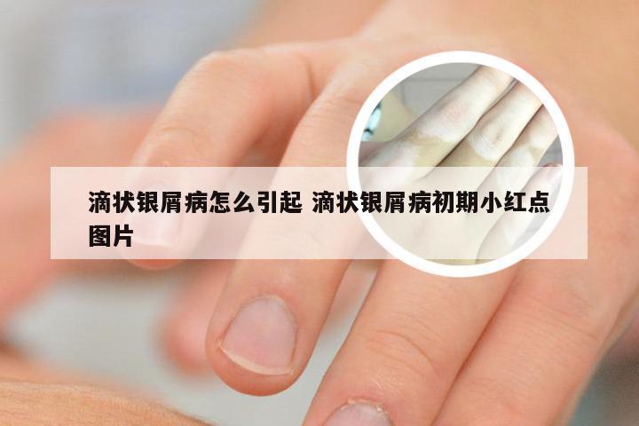 滴状银屑病怎么引起 滴状银屑病初期小红点图片
