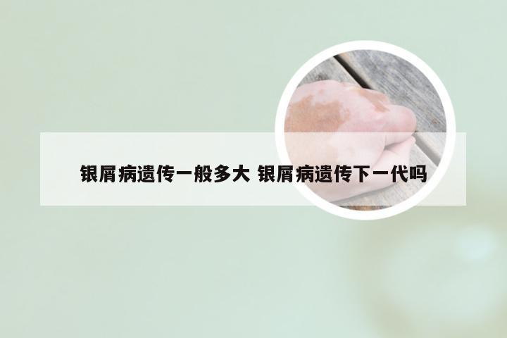 银屑病遗传一般多大 银屑病遗传下一代吗