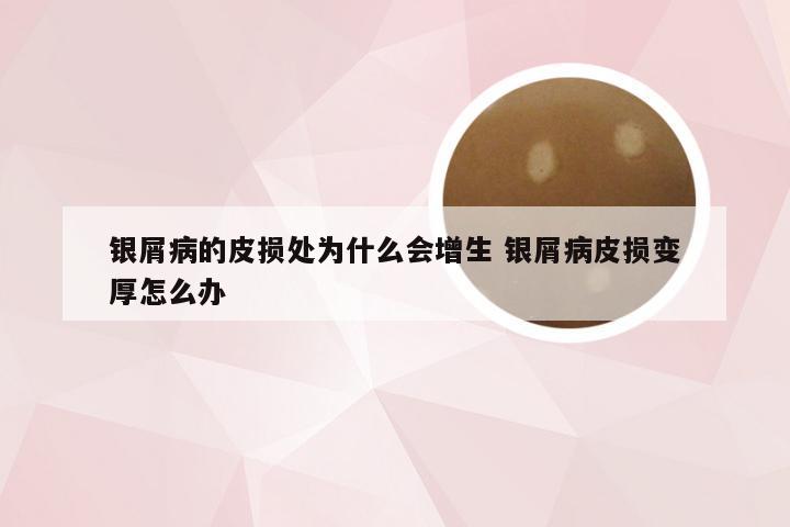 银屑病的皮损处为什么会增生 银屑病皮损变厚怎么办