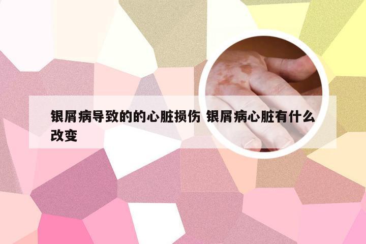银屑病导致的的心脏损伤 银屑病心脏有什么改变