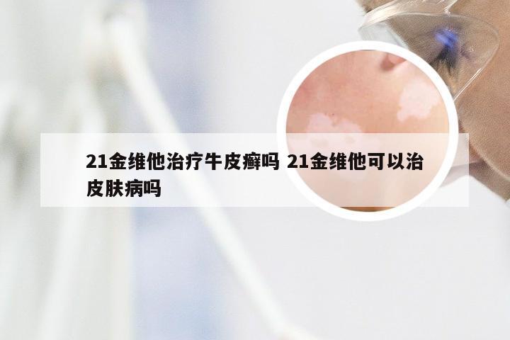 21金维他治疗牛皮癣吗 21金维他可以治皮肤病吗