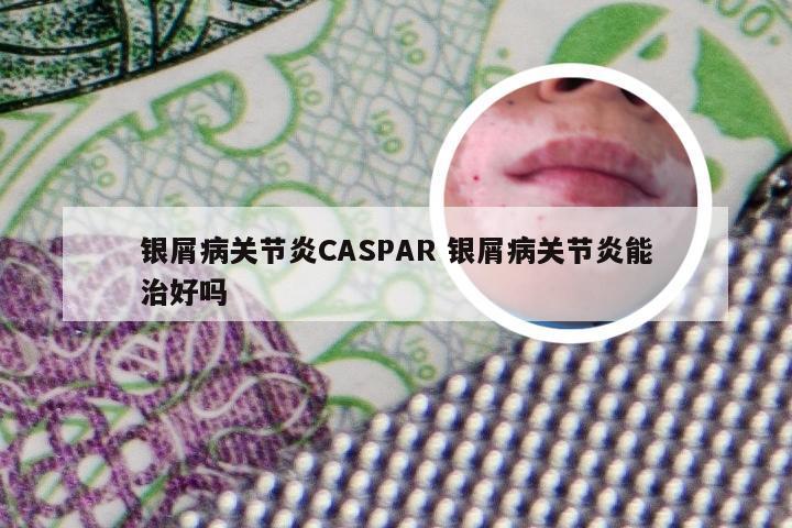 银屑病关节炎CASPAR 银屑病关节炎能治好吗