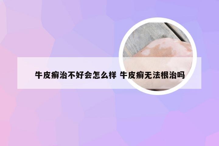 牛皮癣治不好会怎么样 牛皮癣无法根治吗
