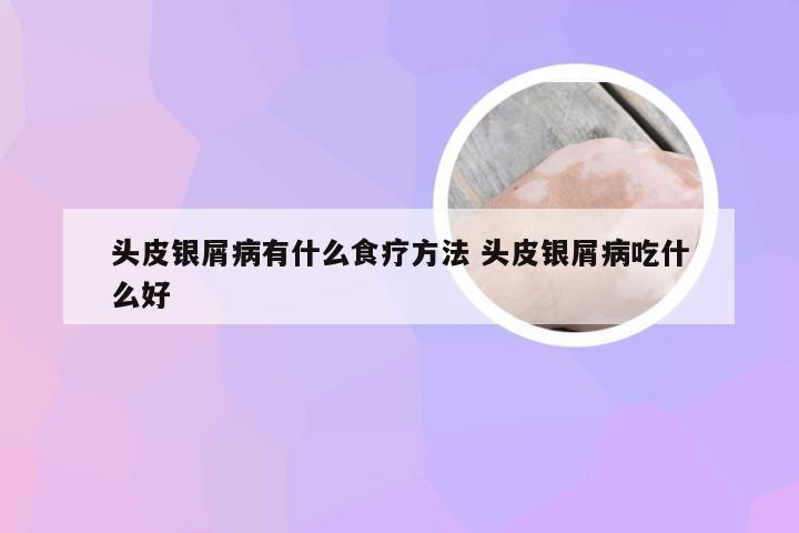 头皮银屑病有什么食疗方法 头皮银屑病吃什么好
