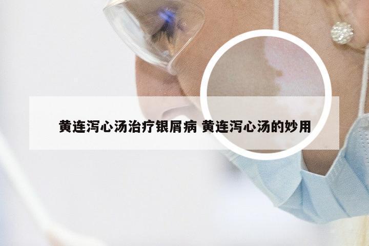 黄连泻心汤治疗银屑病 黄连泻心汤的妙用