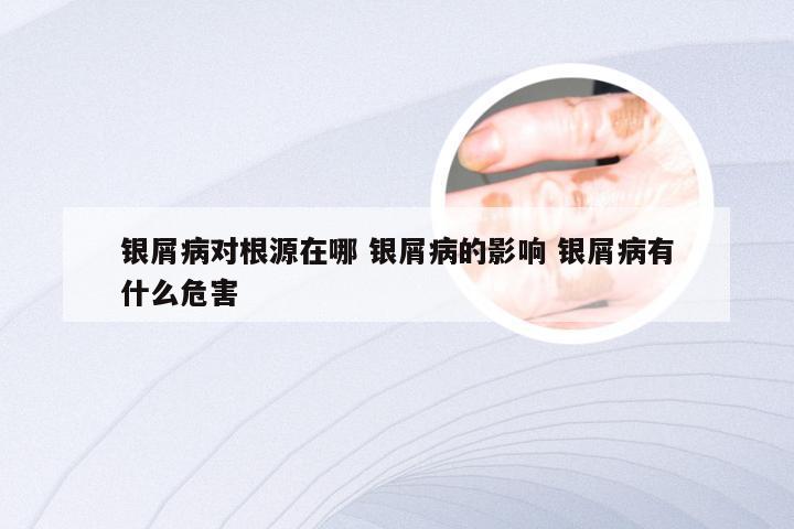 银屑病对根源在哪 银屑病的影响 银屑病有什么危害