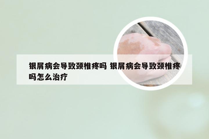 银屑病会导致颈椎疼吗 银屑病会导致颈椎疼吗怎么治疗