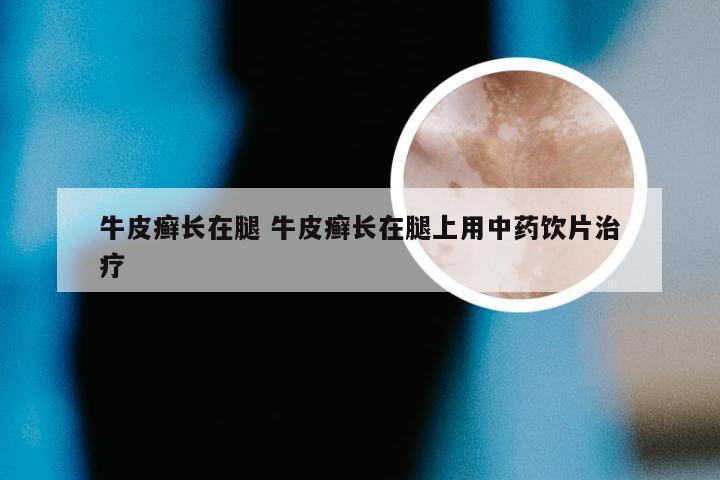 牛皮癣长在腿 牛皮癣长在腿上用中药饮片治疗