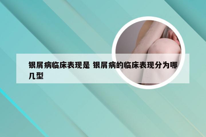 银屑病临床表现是 银屑病的临床表现分为哪几型