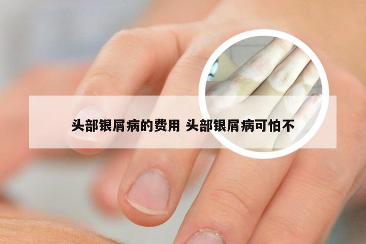 头部银屑病的费用 头部银屑病可怕不