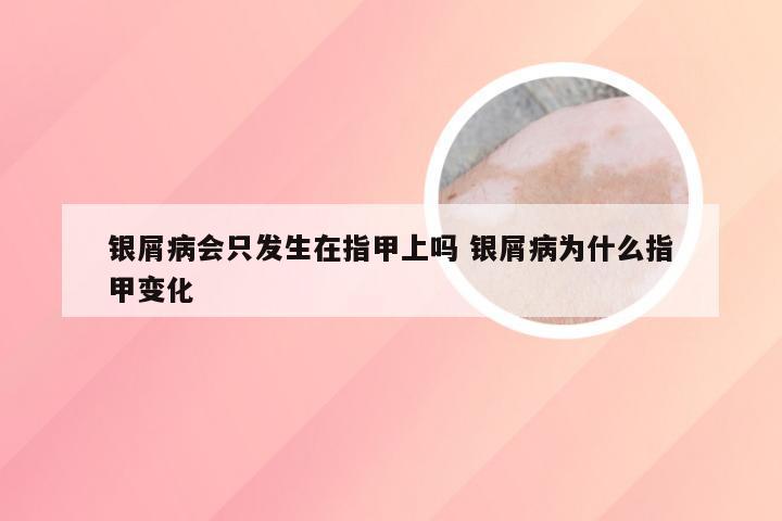 银屑病会只发生在指甲上吗 银屑病为什么指甲变化