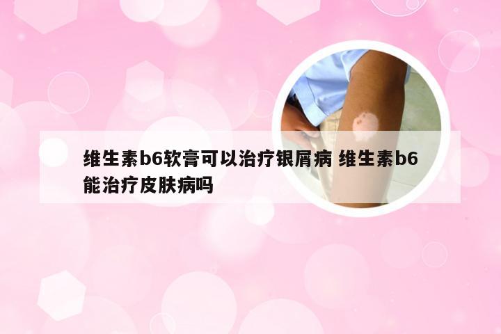 维生素b6软膏可以治疗银屑病 维生素b6能治疗皮肤病吗