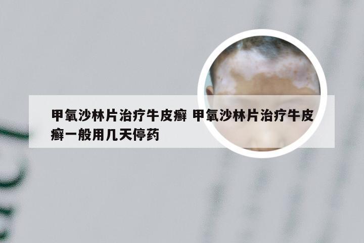甲氧沙林片治疗牛皮癣 甲氧沙林片治疗牛皮癣一般用几天停药