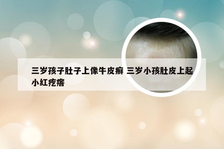 三岁孩子肚子上像牛皮癣 三岁小孩肚皮上起小红疙瘩