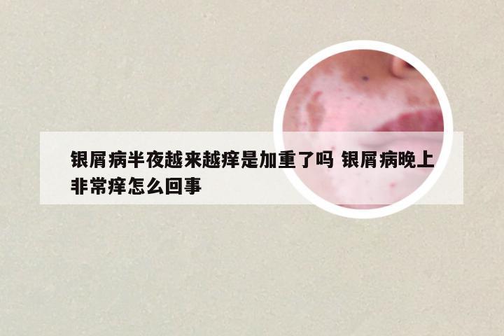 银屑病半夜越来越痒是加重了吗 银屑病晚上非常痒怎么回事