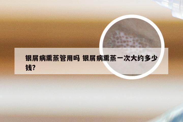 银屑病熏蒸管用吗 银屑病熏蒸一次大约多少钱?