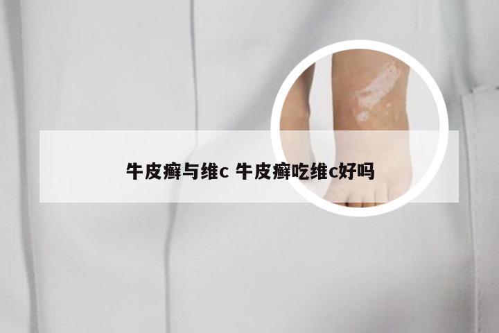 牛皮癣与维c 牛皮癣吃维c好吗
