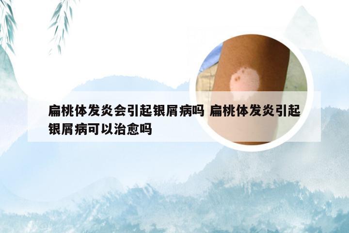 扁桃体发炎会引起银屑病吗 扁桃体发炎引起银屑病可以治愈吗
