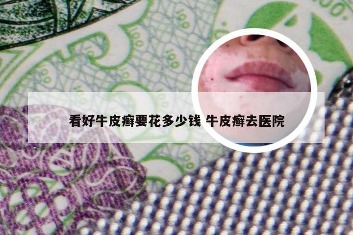 看好牛皮癣要花多少钱 牛皮癣去医院