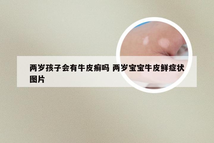 两岁孩子会有牛皮癣吗 两岁宝宝牛皮鲜症状图片