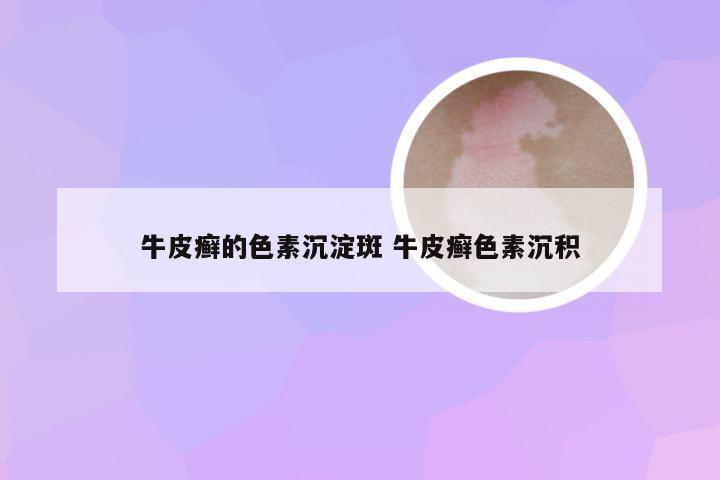 牛皮癣的色素沉淀斑 牛皮癣色素沉积